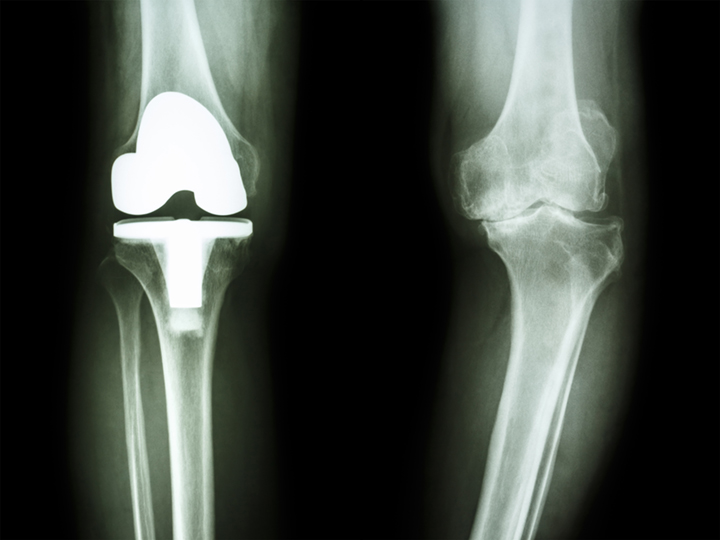 Types of Orthopedic Knee Replacement Surgery Arthritis